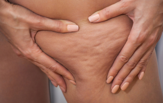 Girl shows holding and pushing the skin of the legs cellulite, orange peel. Treatment and disposal of excess weight, the deposition of subcutaneous fat tissue